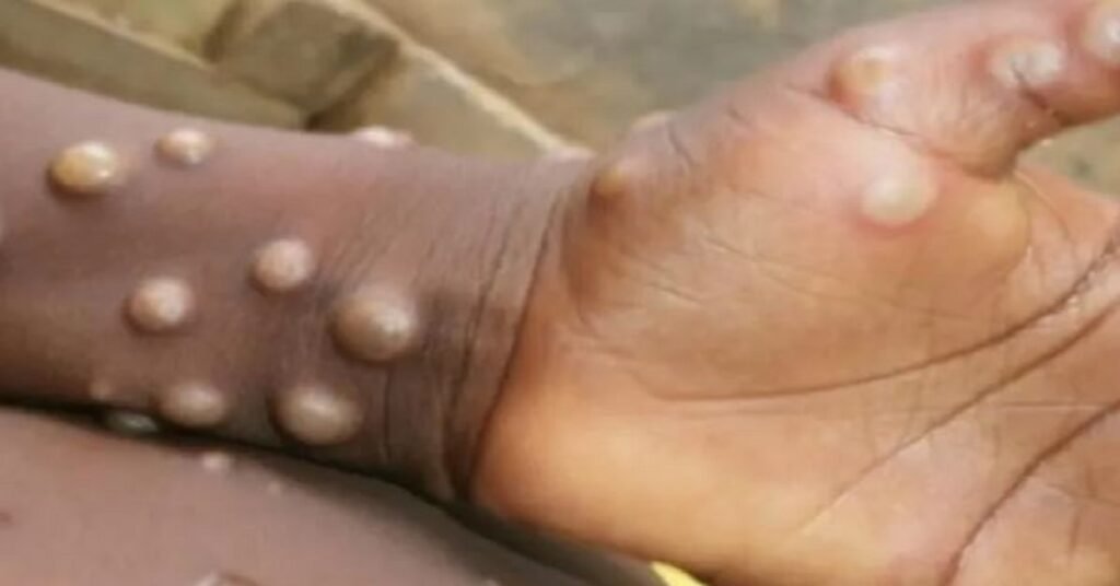 Mpox Virus
